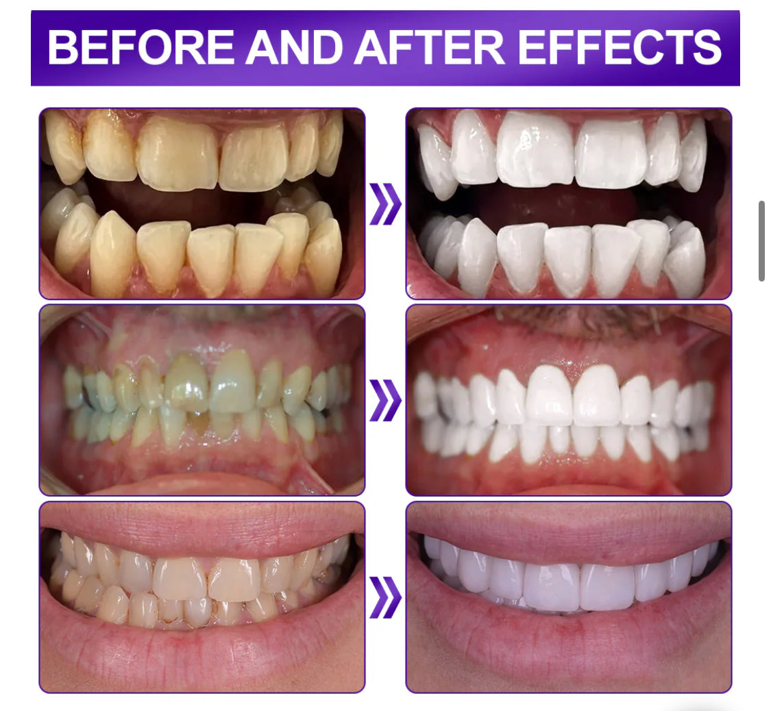 Teeth Whitening Strips™